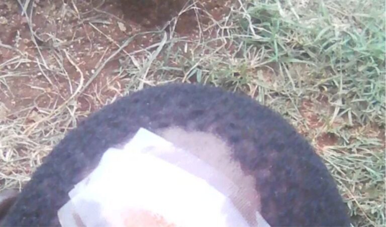 Shock as man bites off attacker’s lip, detaching it from the mouth